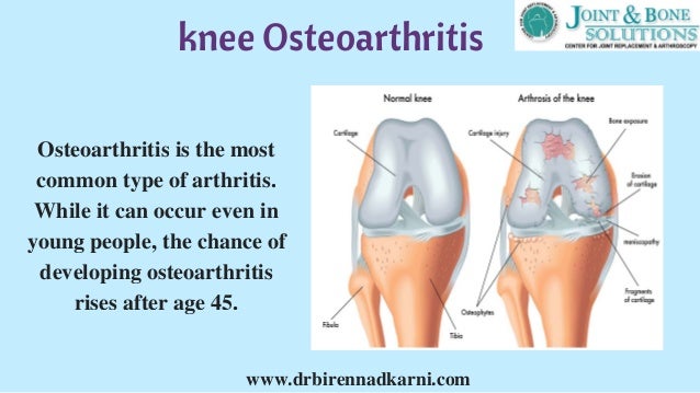 Best Natural Treatment For Osteoarthritis Of The Knee Best Natural Treatment For Osteoarthritis Of The Knee