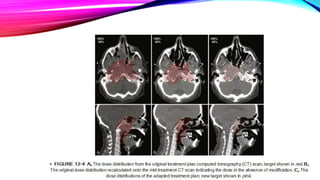 Cd R Radiotherapy Image guided adaptive radiotherapy | PDF