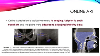 ONLINE ART
• Online Adaptation is typically referred to Imaging Just prior to each
treatment and the plans were adapted to changing anatomy daily.
 