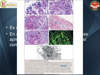 Nefropatía por IgA
• Es una glomerulonefritis mesangia
• En el estudio con microscopio óptico se
aprecia un incremento de la matriz, así
como hipercelularidad mesangial.
 