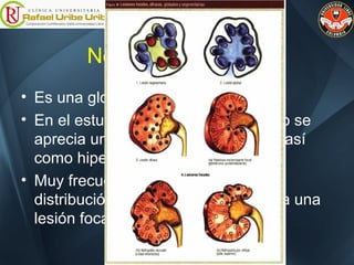 Nefropatía por IgA
• Es una glomerulonefritis mesangia
• En el estudio con microscopio óptico se
aprecia un incremento de la matriz, así
como hipercelularidad mesangial.
• Muy frecuentemente tienen una
distribución segmentaria, asociado a una
lesión focal.
 