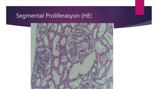 Segmental Proliferasyon (HE)
 