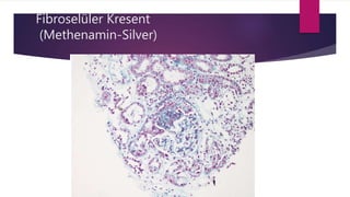 Fibroselüler Kresent
(Methenamin-Silver)
 