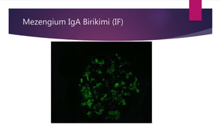 Mezengium IgA Birikimi (IF)
 
