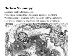 Electron Microscopy
Mesangial electrondense deposits
Immediately beneath the perimesangial basement membrane
Varying degrees of mesangial matrix expansion and hypercellularity.
Foot process effacement in patients with substantial proteinuria.
 