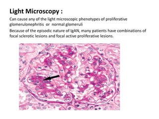 Light Microscopy :
Can cause any of the light microscopic phenotypes of proliferative
glomerulonephritis or normal glomeruli
Because of the episodic nature of IgAN, many patients have combinations of
focal sclerotic lesions and focal active proliferative lesions.
 