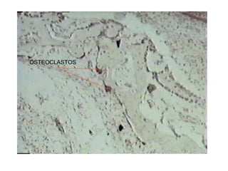 OSTEOCLASTOS
 