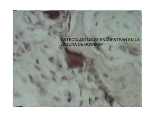 OSTEOCLASTOS SE ENCUENTRAN EN LA
LAGUNA DE HOWSHIP
 