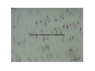 Zona de maduración o hipertrofia
 
