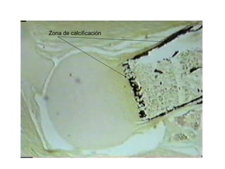 Zona de calcificación
 