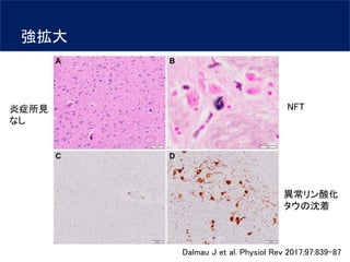 Anti-IgLON5 disease | PDF
