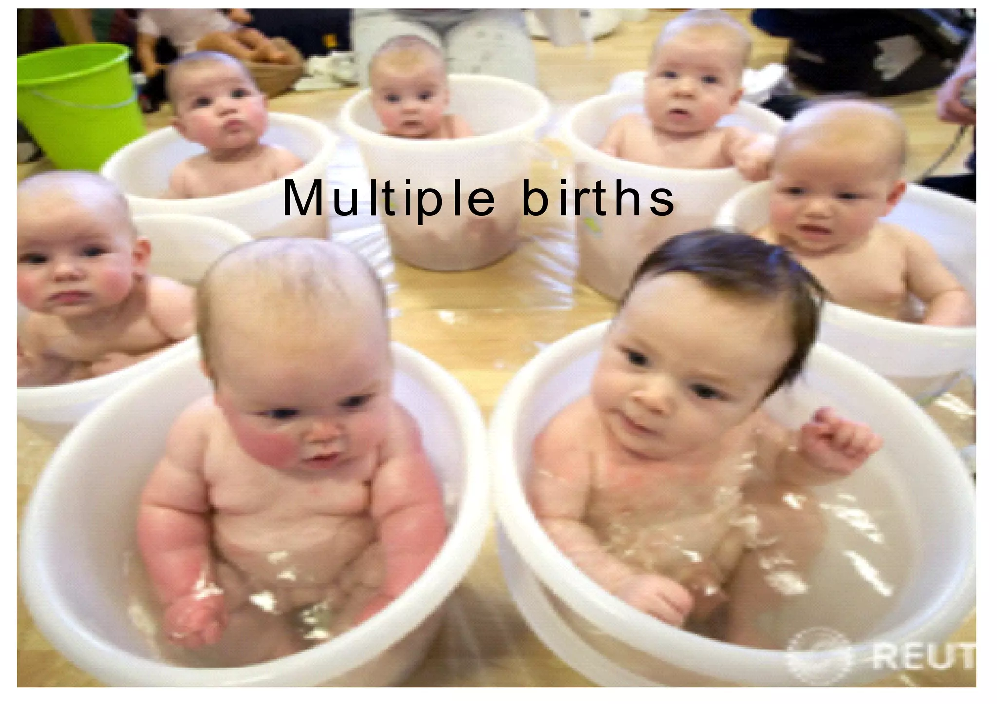 M u lt ip le b irt h s
 