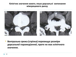 Клінічне значення мають леше дорзальні випинання
міжхрецевого диску
 Вентральна грижа (стрілка) перевищує розміри
дорсальної парамедіанної, проте не має клінічного
значення.
30
 