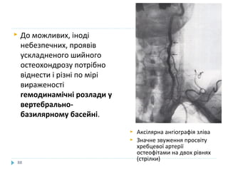  До можливих, іноді
небезпечних, проявів
ускладненого шийного
остеохондрозу потрібно
віднести і різні по мірі
вираженості
гемодинамічні розлади у
вертебрально-
базилярному басейні.
88
 Аксілярна ангіографія зліва
 Значне звуження просвіту
хребцевої артерії
остеофітами на двох рівнях
(стрілки)
 