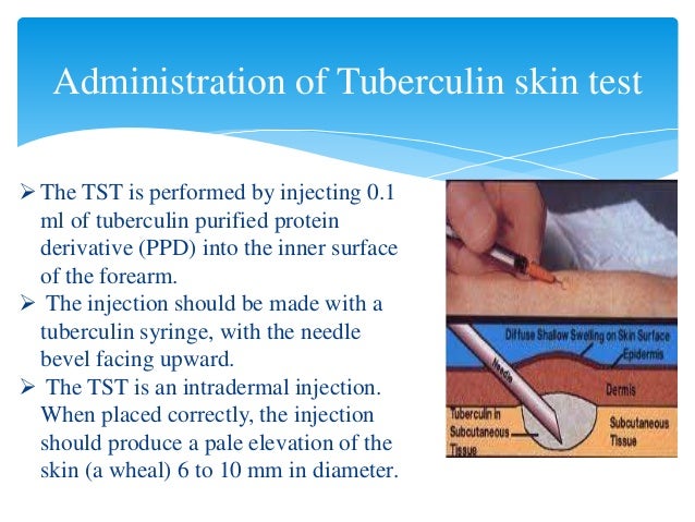 IGRA TUBERCULIN SKIN TEST igra-tuberculin-skin-test