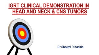 IGRT CLINICAL DEMONSTRATION IN
HEAD AND NECK & CNS TUMORS
Dr Sheetal R Kashid
 