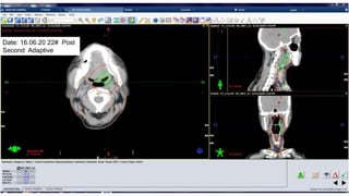 Image Guided Radiotherapy | PPTX