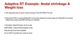 Adaptive Rt Example Image Guided Radiotherapy | PPTX