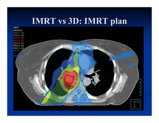 Igrt Srt For Lung Cancer