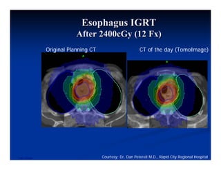 Igrt Srt For Lung Cancer