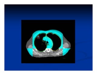Igrt Srt For Lung Cancer