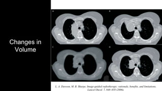 Changes in
Volume
L. A. Dawson, M. B. Sharpe, Image-guided radiotherapy: rationale, benefits, and limitations.
Lancet Oncol. 7, 848–858 (2006).
 