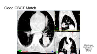 Good CBCT Match
Slide Image
courtesy Dr J P
Aggarwal
(TMH)
 