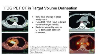 FDG PET CT in Target Volume Delineation
Y. Zheng et al., FDG-PET/CT imaging for tumor staging
and definition of tumor volumes in radiation treatment
planning in non-small cell lung cancer. Oncol. Lett. 7,
1015–1020 (2014).
● 35% have change in stage
assignment
● Fused CT / PET result in target
volume changes in 60%
● Reduced variability seen in
GTV delineation between
observers.
 