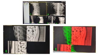 Cd R Radiotherapy Image Guided Radiotherapy | PDF