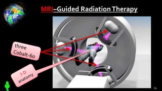 MRI–Guided RadiationTherapy
61
 