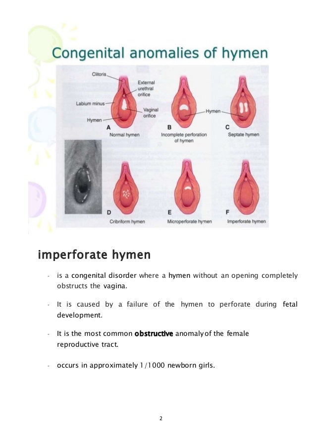 Imperforate Hymen Pictures 48