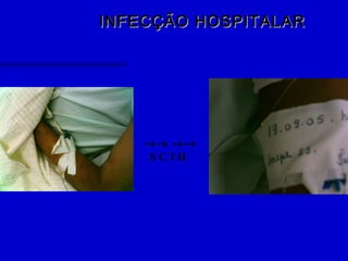 INFECÇÃO HOSPITALARINFECÇÃO HOSPITALAR
→→ →→
S C I H
 