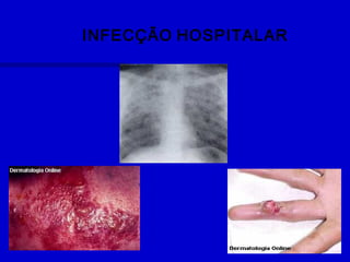 INFECÇÃO HOSPITALAR
 