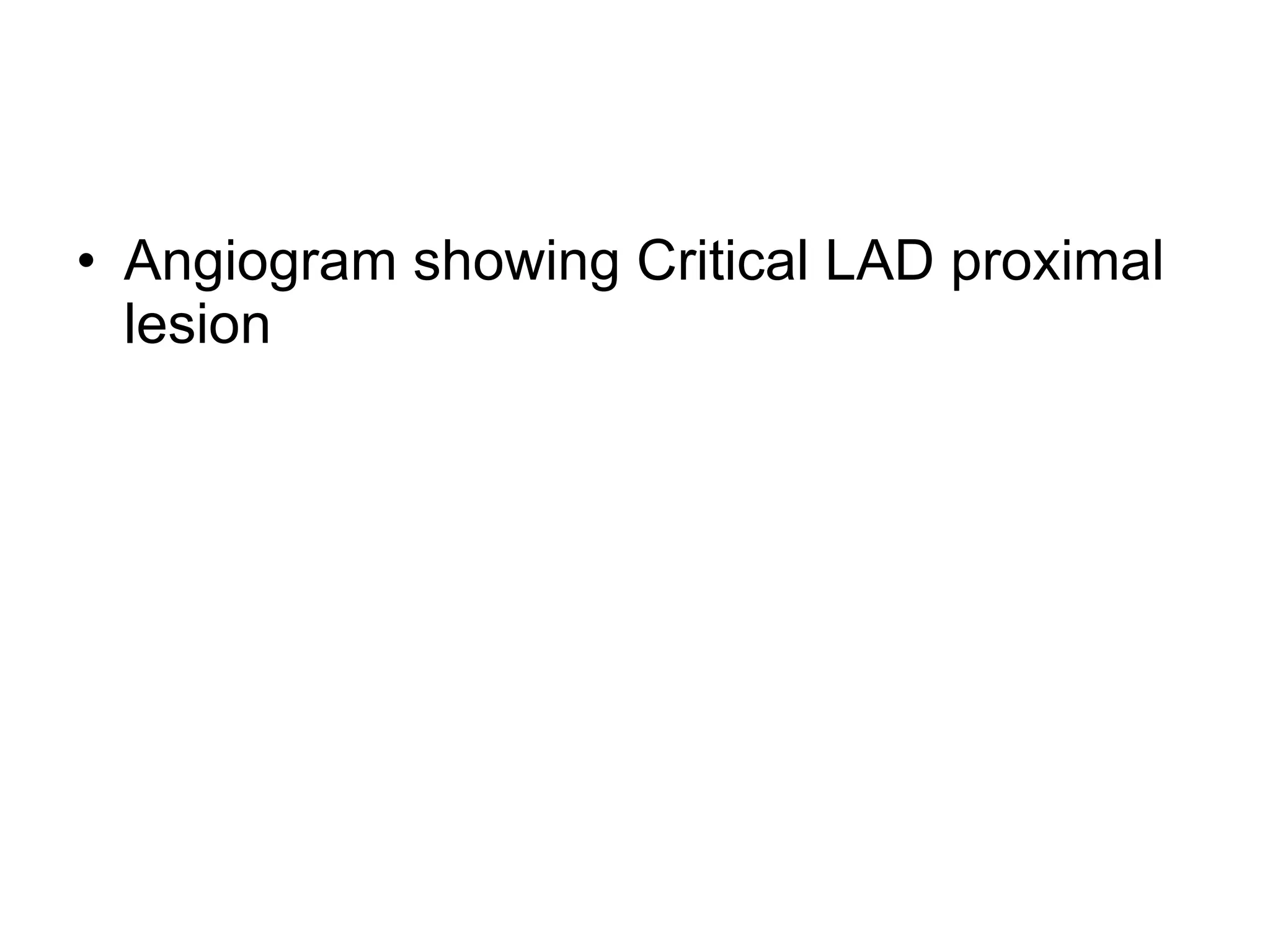 Angiogram showing Critical LAD proximal lesion