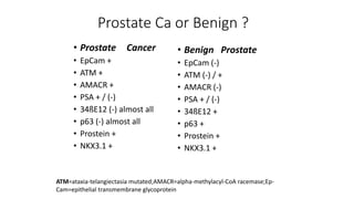 Prostate Ca or Benign ?
• Prostate Cancer
• EpCam +
• ATM +
• AMACR +
• PSA + / (-)
• 34ßE12 (-) almost all
• p63 (-) almost all
• Prostein +
• NKX3.1 +
• Benign Prostate
• EpCam (-)
• ATM (-) / +
• AMACR (-)
• PSA + / (-)
• 34ßE12 +
• p63 +
• Prostein +
• NKX3.1 +
ATM=ataxia-telangiectasia mutated;AMACR=alpha-methylacyl-CoA racemase;Ep-
Cam=epithelial transmembrane glycoprotein
 