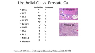 Urothelial Ca vs Prostate Ca
• EMA
• CK7
• P63
• CK5/6
• EpCam
• CD57
• PSA
• PAP
• NKX3.1
• Prostein
+ -
+ -
+/- 0
+/- 0
+/- 0
-/+ +/-
0 +
0 +/-
0 +
0 +
0 +
Urothelial ca Prostate ca
Hammerich KH.Archives of Pathology and Laboratory Medicine;132(3):432-440
Urothelial ca
Prostate ca
 