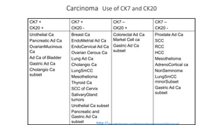 Carcinoma Use of CK7 and CK20
CK7 +
CK20 +
CK7 +
CK20 -
CK7 –
CK20 +
CK7 –
CK20 -
Urothelial Ca
Pancreatic Ad Ca
OvarianMucinous
Ca
Ad Ca of Bladder
Gastric Ad Ca
Cholangio Ca
subset
Breast Ca
EndoMetrial Ad Ca
EndoCervical Ad Ca
Ovarian Cerous Ca
Lung Ad Ca
Cholangio Ca
LungSmCC
Mesothelioma
Thyroid Ca
SCC of Cervix
SalivaryGland
tumors
Urothelial Ca subset
Pancreatic and
Gastric Ad Ca
subset
Colorectal Ad Ca
Markel Cell ca
Gastric Ad Ca
subset
Prostate Ad Ca
SCC
RCC
HCC
Mesothelioma
AdrenoCortical ca
NonSeminoma
LungSmCC
minorSubset
Gastric Ad Ca
subset
http://www.pathinformatics.com/department/documents/SusanE%20Lecture.pdf
 