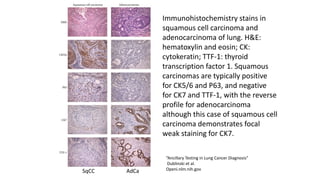 Immunohistochemistry stains in
squamous cell carcinoma and
adenocarcinoma of lung. H&E:
hematoxylin and eosin; CK:
cytokeratin; TTF-1: thyroid
transcription factor 1. Squamous
carcinomas are typically positive
for CK5/6 and P63, and negative
for CK7 and TTF-1, with the reverse
profile for adenocarcinoma
although this case of squamous cell
carcinoma demonstrates focal
weak staining for CK7.
SqCC AdCa
“Ancillary Testing in Lung Cancer Diagnosis”
Dublinski et al.
Openi.nlm.nih.gov
 