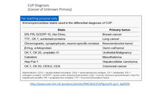 CUP Diagnosis
(Cancer of Unknown Primary)
http://www.ncbi.nlm.nih.gov/pmc/articles/PMC2631214/figure/f1-gcr1_6p0229/
For teaching purpose only
 
