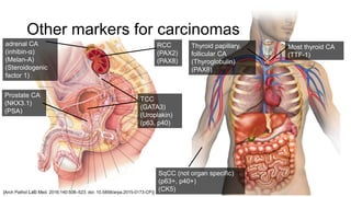 Other markers for carcinomas
Prostate CA
(NKX3.1)
(PSA)
TCC
(GATA3)
(Uroplakin)
(p63, p40)
RCC
(PAX2)
(PAX8)
Thyroid papillary,
follicular CA
(Thyroglobulin)
(PAX8)
Most thyroid CA
(TTF-1)
adrenal CA
(inhibin-α)
(Melan-A)
(Steroidogenic
factor 1)
SqCC (not organ specific)
(p63+, p40+)
(CK5)[Arch Pathol Lab Med. 2016;140:508–523; doi: 10.5858/arpa.2015-0173-CP)]
 