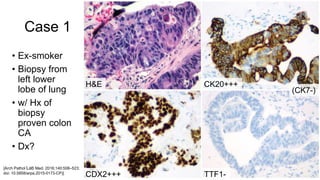 Case 1
• Ex-smoker
• Biopsy from
left lower
lobe of lung
• w/ Hx of
biopsy
proven colon
CA
• Dx?
CK20+++H&E
CDX2+++ TTF1-
(CK7-)
[Arch Pathol Lab Med. 2016;140:508–523;
doi: 10.5858/arpa.2015-0173-CP)]
 