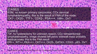 [CASE2]
63M, no known primary carcinoma, CCx cervical
lymphadenopathy, this is the result of FNA of the node:
CK7-, CK20-, TTF1-, CDX2-, PSA+++, Villin-. Dx?
[CASE3]
73F, hx hysterectomy for unknown reason, CCx retroperitoneal
lymphadenopathy, image showed left pelvic sidewall mass probably
residual ovary. this is the FNA result:
ER++, WT++, PAX+++, CK7+++, CK20-, GATA3-, CDX2-, p63-. Dx?
[Arch Pathol Lab Med. 2016;140:508–523; doi: 10.5858/arpa.2015-0173-CP)]
 
