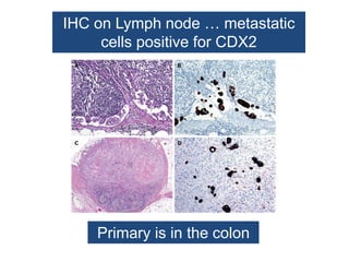 IHC on Lymph node … metastatic
cells positive for CDX2
Primary is in the colon
 