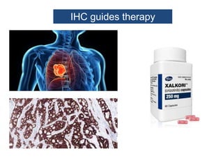 IHC guides therapy
 