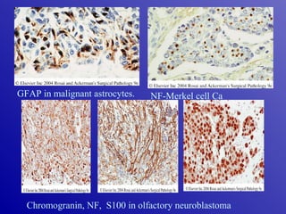 GFAP in malignant astrocytes. NF-Merkel cell Ca
Chromogranin, NF, S100 in olfactory neuroblastoma
 