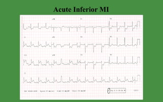 Acute Inferior MI 