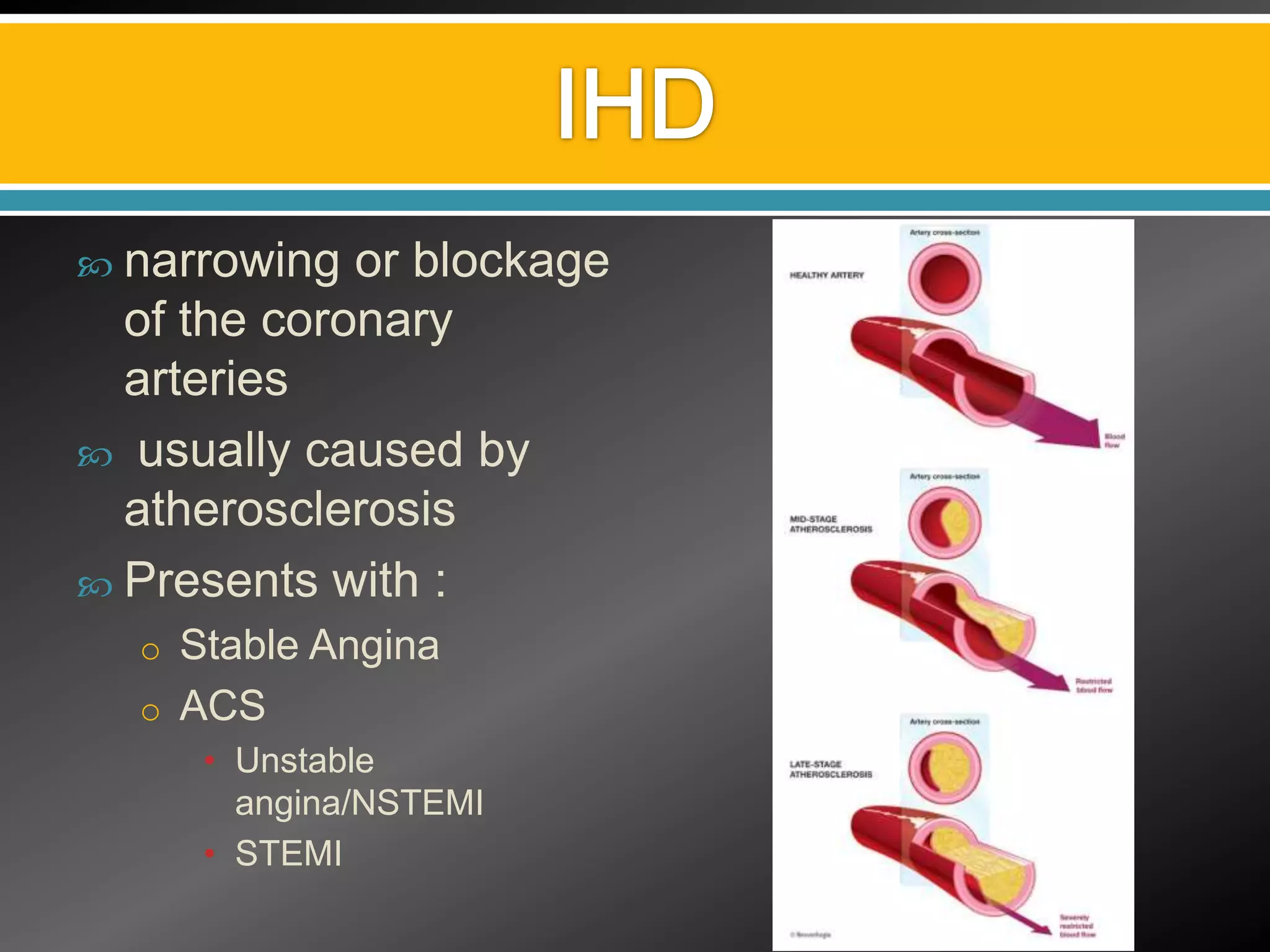  narrowing  or blockage
  of the coronary
  arteries
 usually caused by
  atherosclerosis
 Presents with :
  o Stable Angina
  o ACS
     • Unstable
       angina/NSTEMI
     • STEMI
 