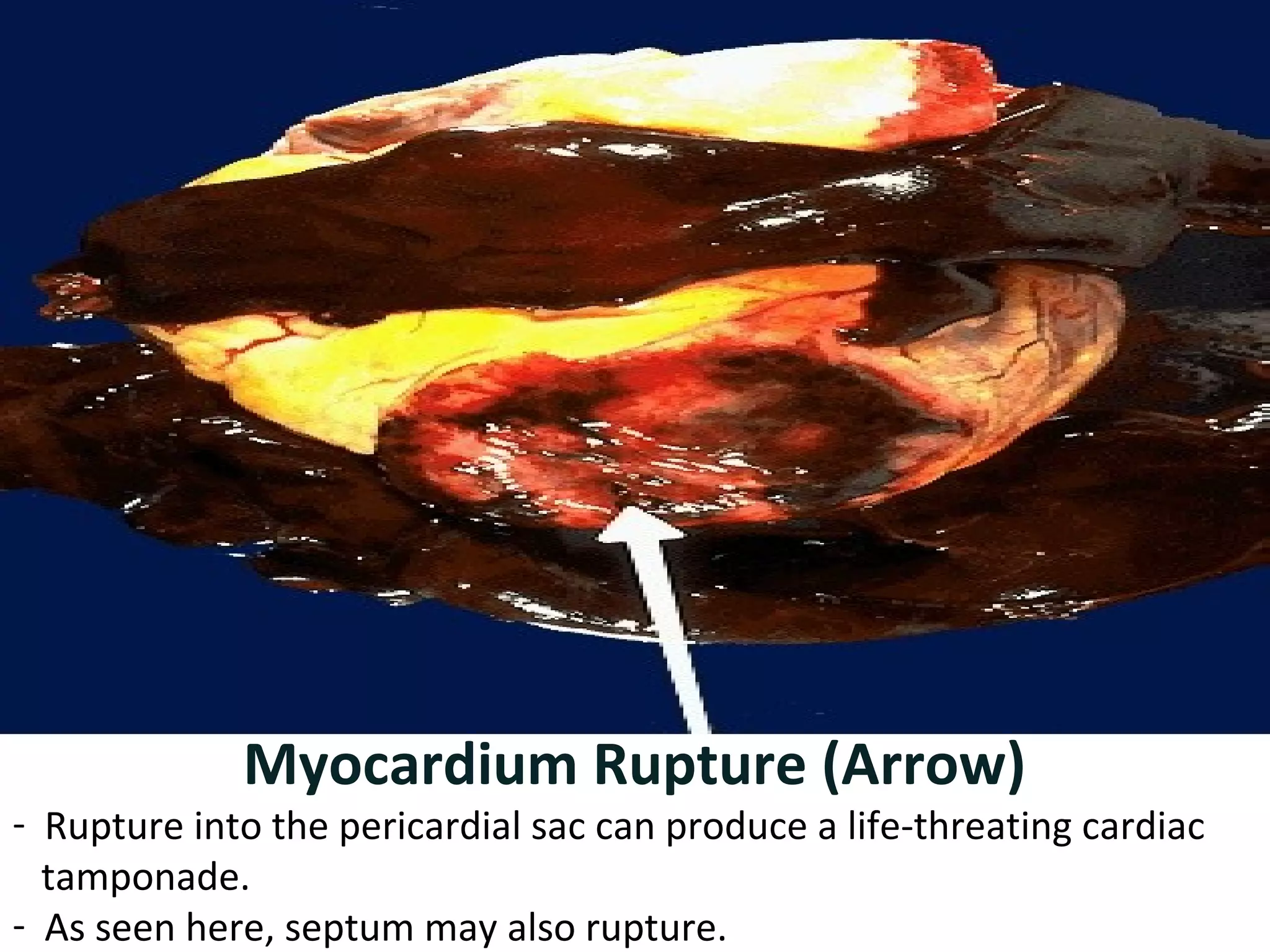 Myocardium Rupture (Arrow) 
- Rupture into the pericardial sac can produce a life-threating cardiac 
tamponade. 
- As seen here, septum may also rupture. 
 