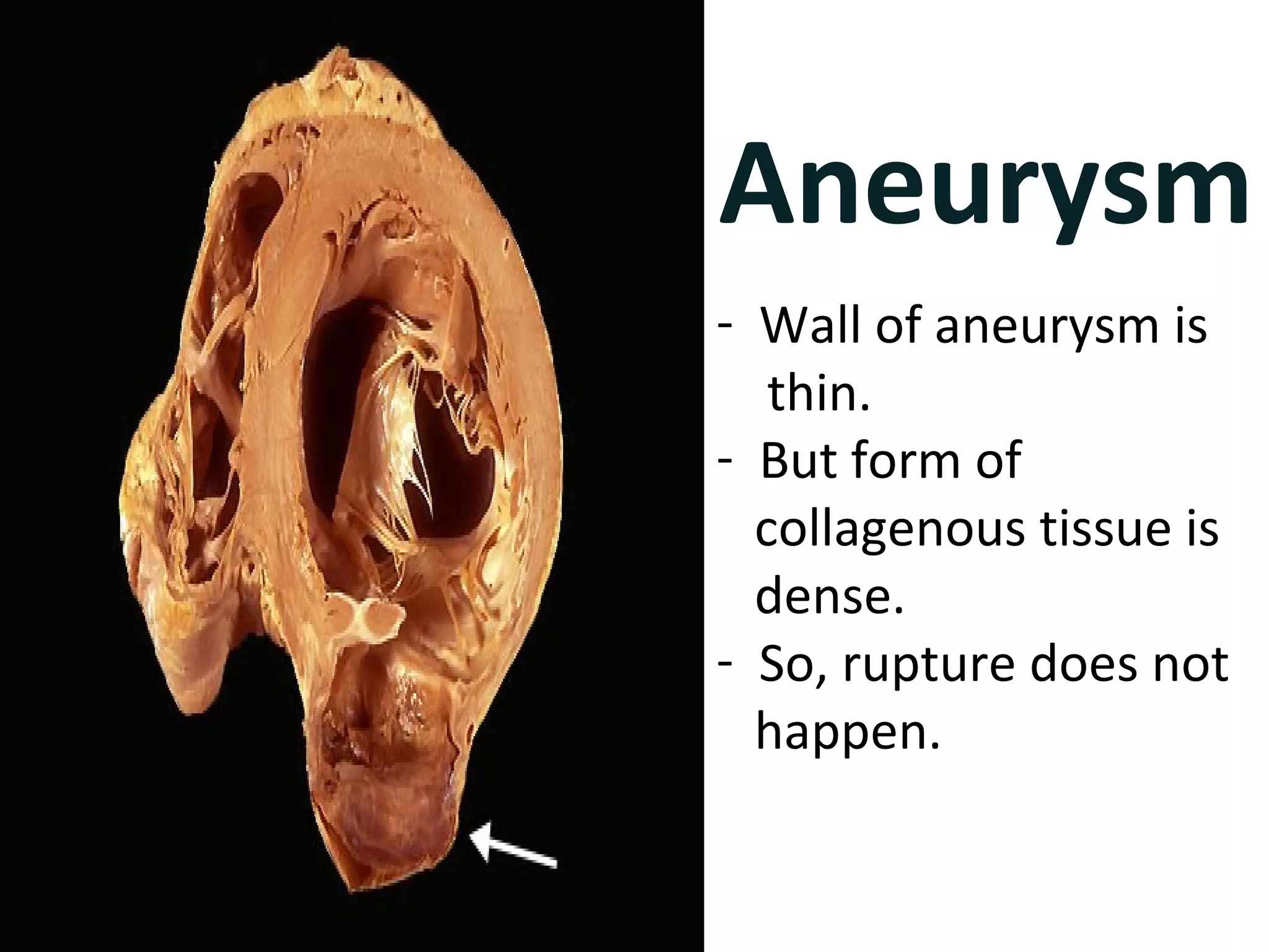Aneurysm 
- Wall of aneurysm is 
thin. 
- But form of 
collagenous tissue is 
dense. 
- So, rupture does not 
happen. 
 