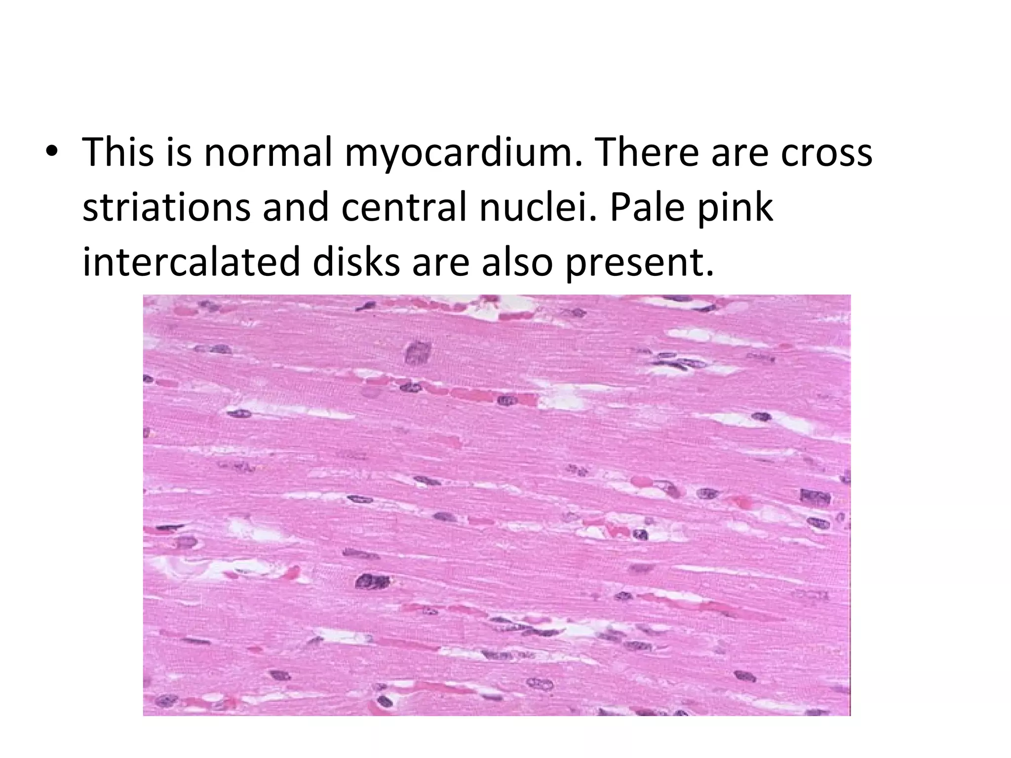 • This is normal myocardium. There are cross 
striations and central nuclei. Pale pink 
intercalated disks are also present. 
 